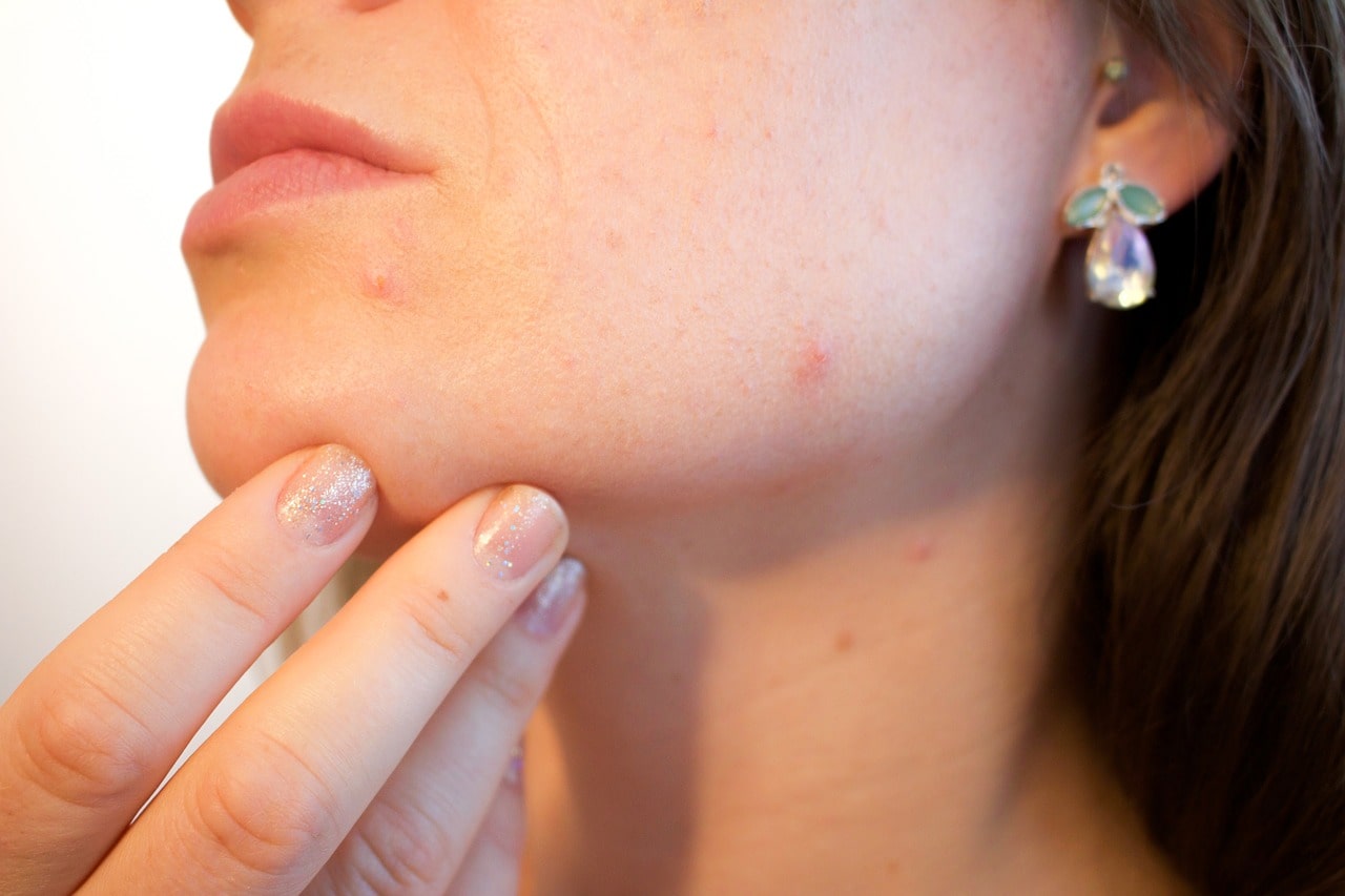 Types of Acne, Symptoms and Treatments